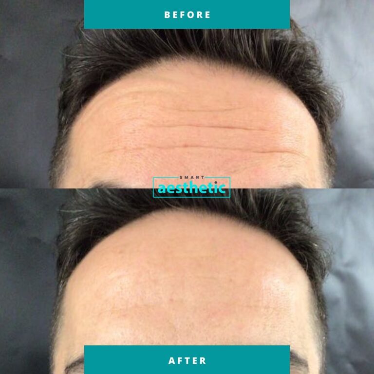 Anti-wrinkle treatment before and after
