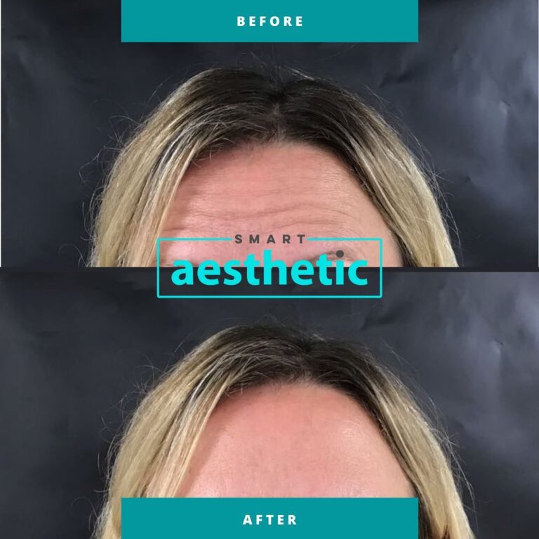 Anti-wrinkle treatment before and after