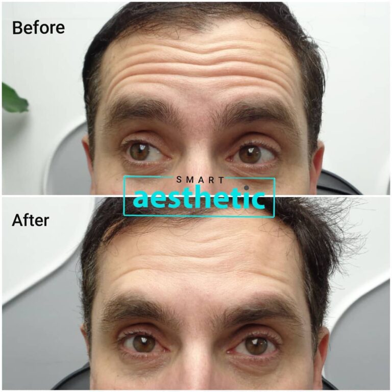 Anti-wrinkle treatment before and after