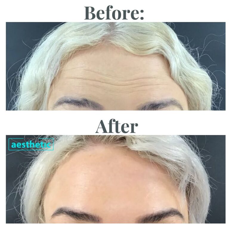 Anti-wrinkle treatment before and after