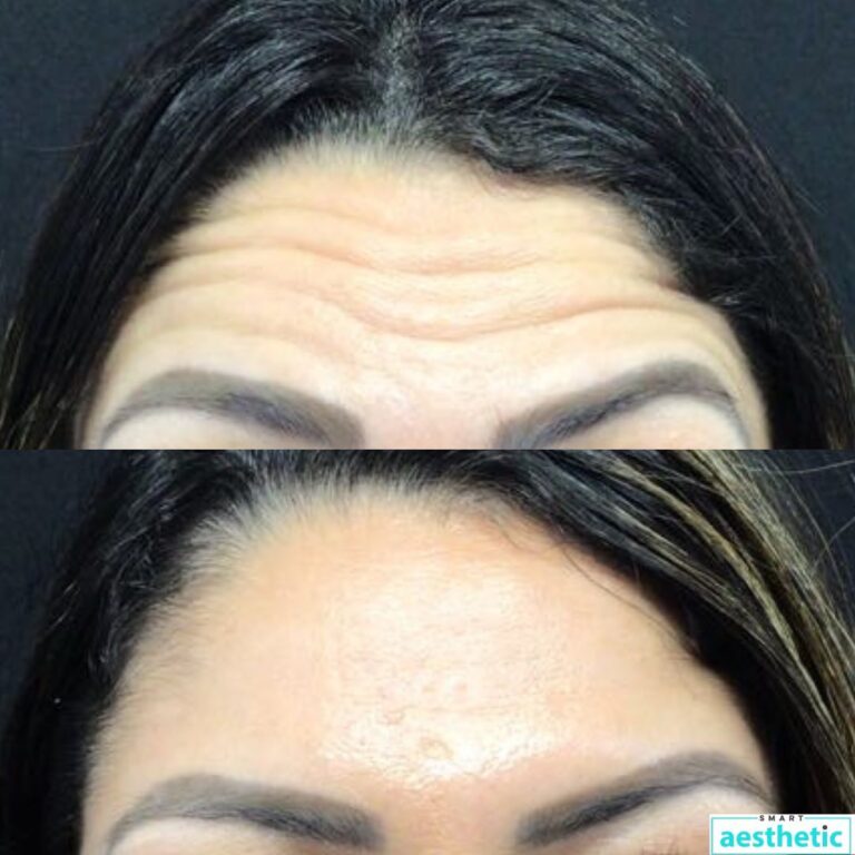 Anti-wrinkle treatment before and after
