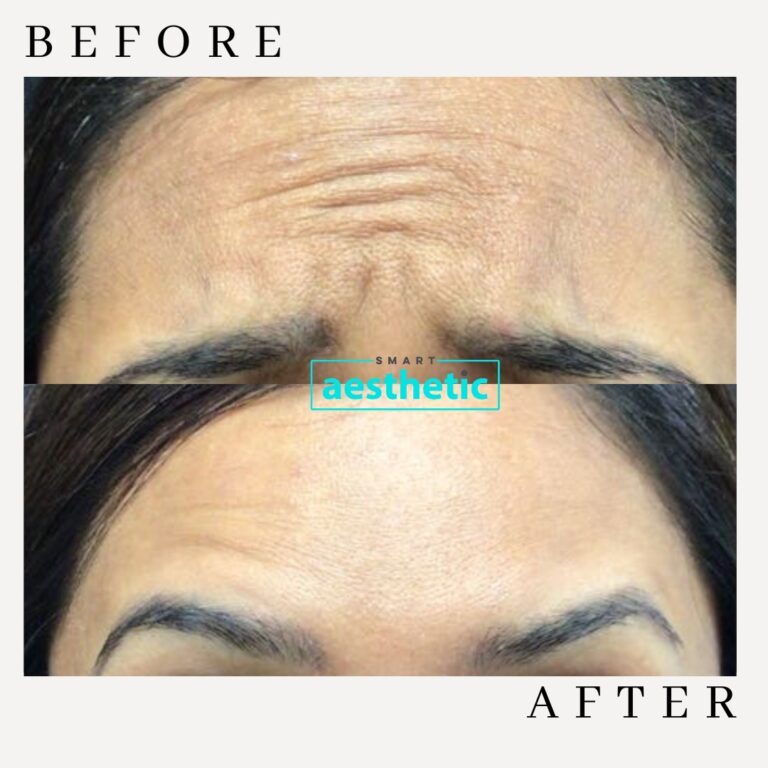 Anti-wrinkle treatment before and after