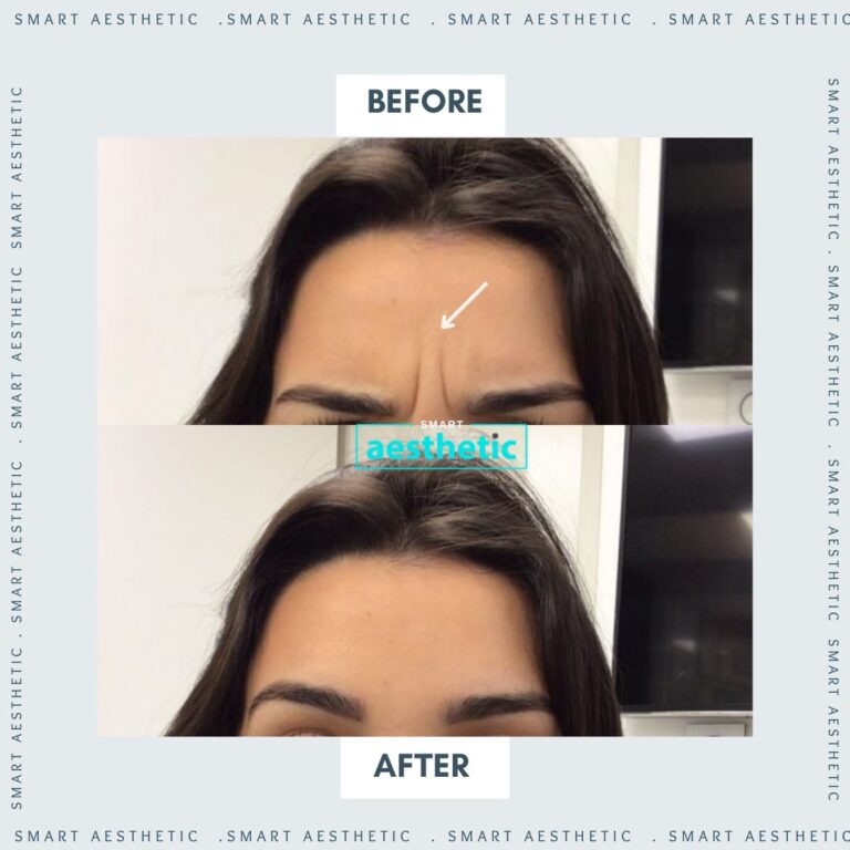 Anti-wrinkle treatment before and after