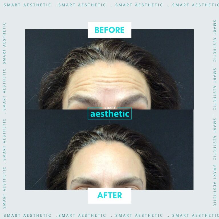 Anti-wrinkle treatment before and after