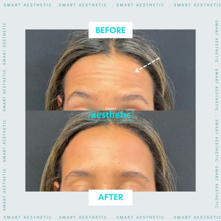 Anti-wrinkle treatment before and after