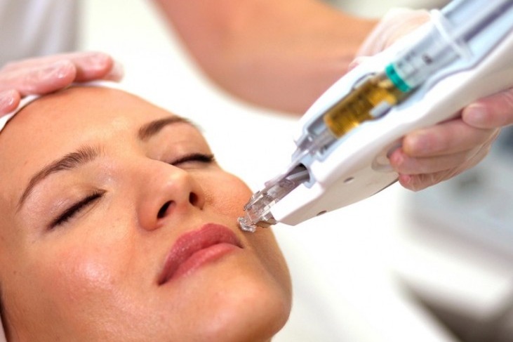 Microneedling device used at Smart Aesthetic