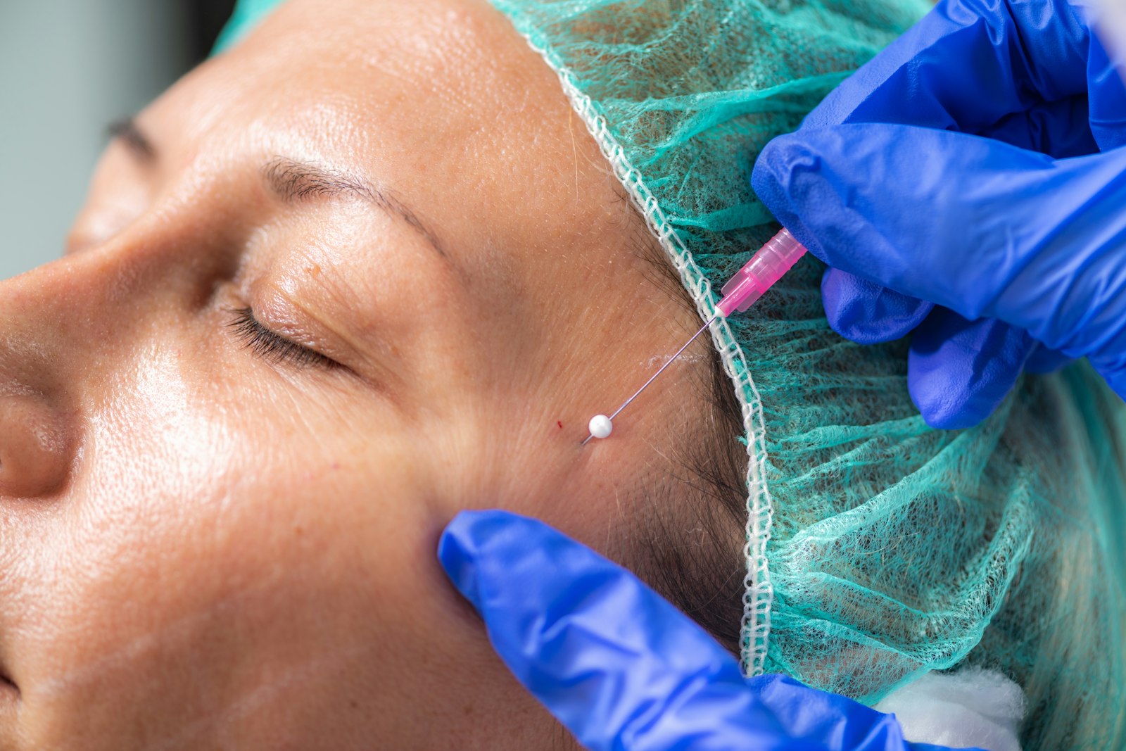PDO thread lift treatment