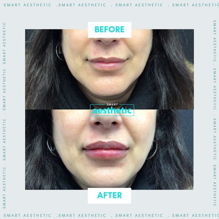 Lip filler before and after