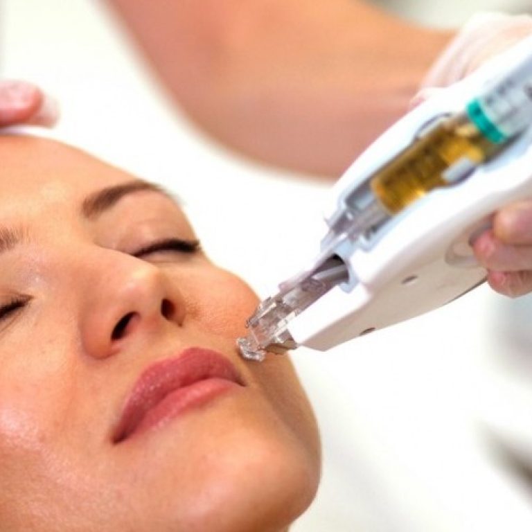 Microneedling device used at Smart Aesthetic