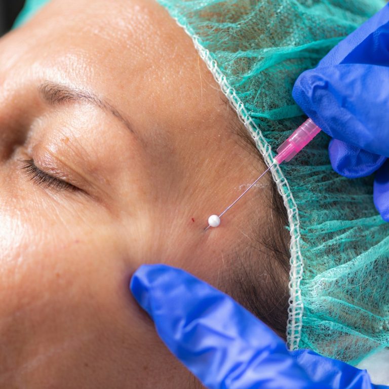 PDO thread lift treatment
